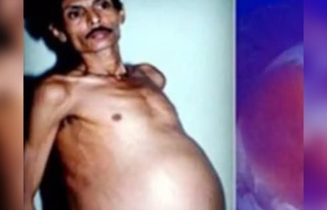 במשך שנים צחקו עליו שהוא ‘בהריון’ – אבל מה שיצא ממנו בניתוח השאיר את כולם בשוק