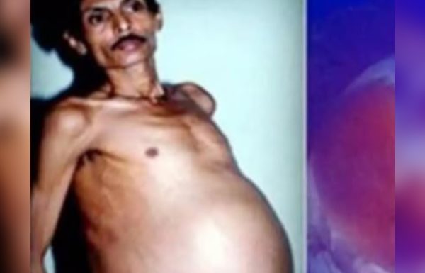 במשך שנים צחקו עליו שהוא ‘בהריון’ – אבל מה שיצא ממנו בניתוח השאיר את כולם בשוק