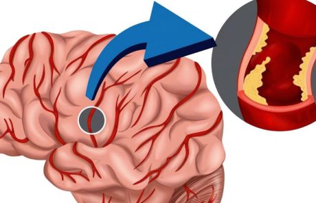 הגוף שלכם מזהיר אתכם 24 שעות לפני שבץ מוחי: אלו הסימנים הנסתרים שכולם צריכים להכיר
