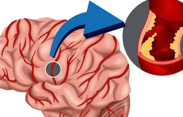 הגוף שלכם מזהיר אתכם 24 שעות לפני שבץ מוחי: אלו הסימנים הנסתרים שכולם צריכים להכיר