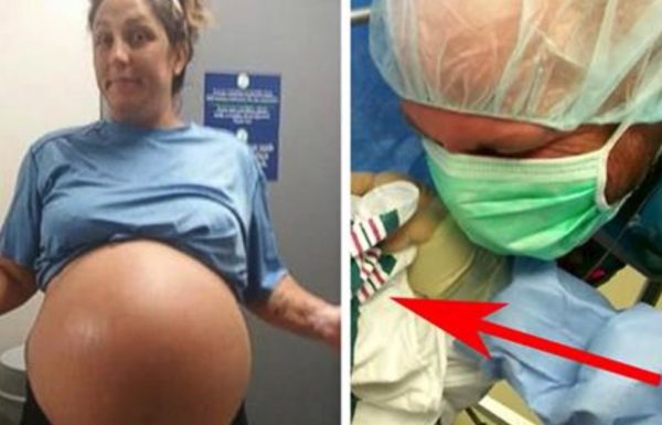 הבטן הענקית של אמא לא הפסיקה לגדול – כשהרופאים ביצעו ניתוח קיסרי, הסוד הענק נחשף
