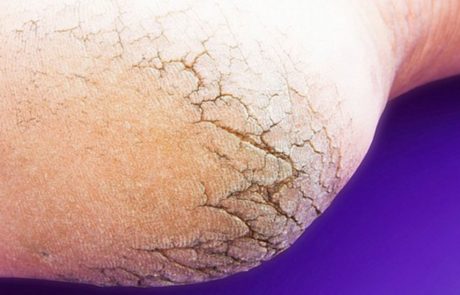 אל תבזבזו כסף על פדיקור יקר – שני המרכיבים האלה מהמטבח יכולים להציל את כפות הרגליים שלכם