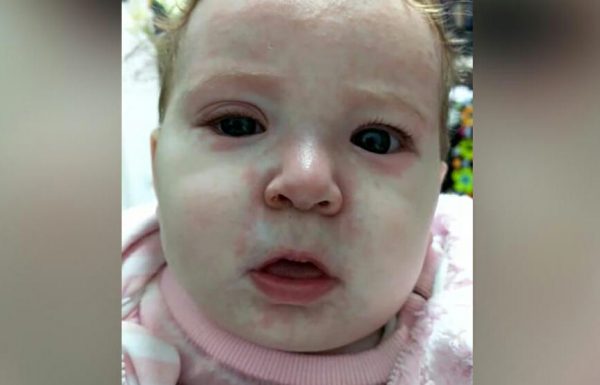 התינוקת הזו נדבקה בחצבת בגלל מתנגדי חיסונים