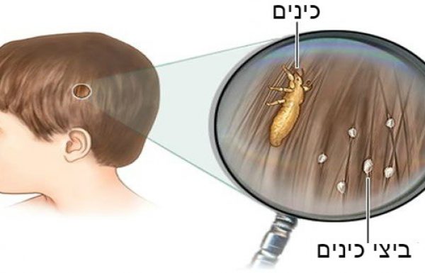 רופאים לא יגלו לכם את זה – דרך זולה, יעילה וטבעית להיפטר מכינים באופן מיידי!