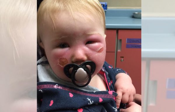 תינוקת סבלה מכוויות קשות – עכשיו אמא שלה רוצה להזהיר אחרים מפני הקרם הנפוץ הזה
