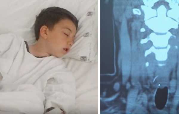 הילד הזה סבל מכאב נוראי בבטן אחרי שאכל המבורגר – בבית החולים הם גילו את הסיבה המזעזעת