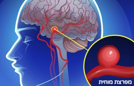 12 סימני אזהרה מוקדמים למפרצת מוחית שאסור לכם להתעלם מהם!