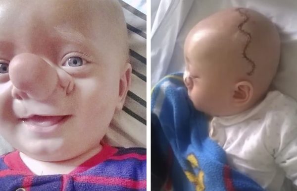'ילד פינוקיו' היה קורבן לבריונות בגלל האף: 3 שנים אחר כך המהפך שלו הושלם בזכות הרופאים