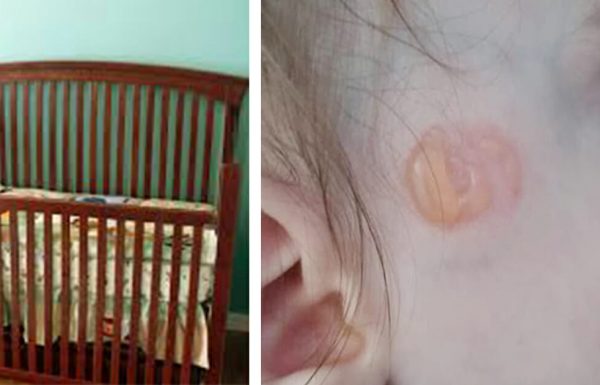 אמא התעוררה מהצרחות של התינוק – הבחינה בסימן מוזר על הפנים שלו ומיד נסעה לבית חולים