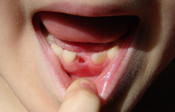 רופאים מזהירים הורים: אל תזרקו את שיני החלב של הילדים שלכם