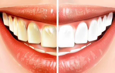 עשו את זה לפני שאתם מצחצחים שיניים – וחסכו מאות שקלים על טיפולי שיניים!