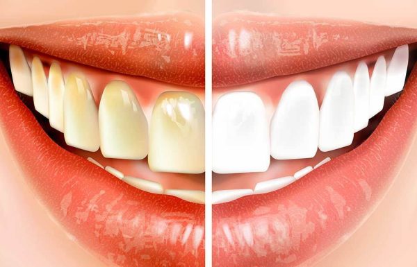 עשו את זה לפני שאתם מצחצחים שיניים – וחסכו מאות שקלים על טיפולי שיניים!