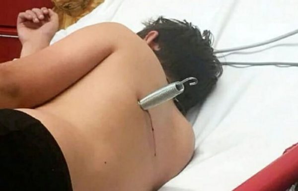 ילד בן 12 שרד לאחר שקפיץ של טרמפולינה ניקב לו את הגב: “עף כמו כדור של אקדח”