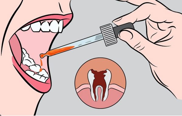 שימו כמה טיפות של התרופה הטבעית הזו בפה, והיפטרו בשניות מכאבי השיניים