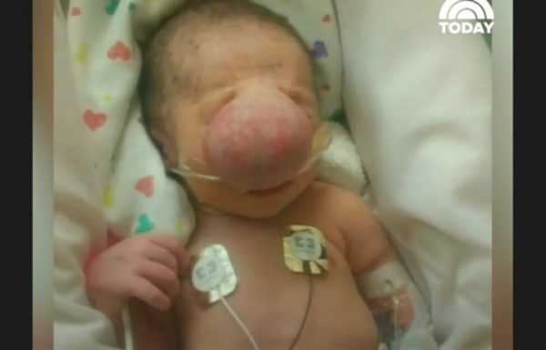 רופאים הסירו שק ענק מהפנים של התינוק – מה שהיה מתחת הביא אותם לדמעות